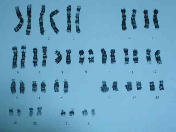 5号染色体微重复一般都是遗传导致的吗？