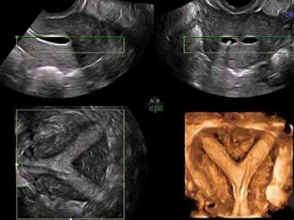 双角子宫做试管能移植两个胚胎怀双胞胎吗？