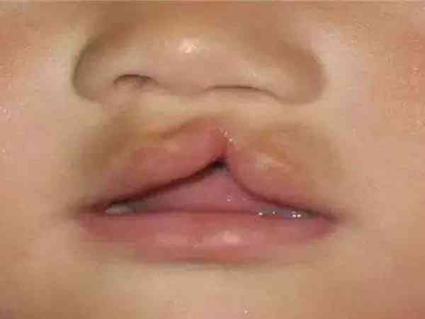 女方先天性唇腭裂可以做三代试管阻断遗传吗？