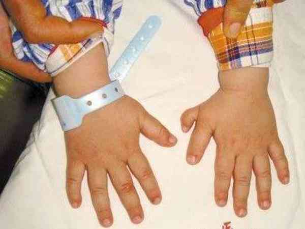 多指畸形可以做3代试管避免遗传吗？