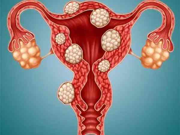 哪4种活血化瘀的食物是子宫肌瘤天然克星？