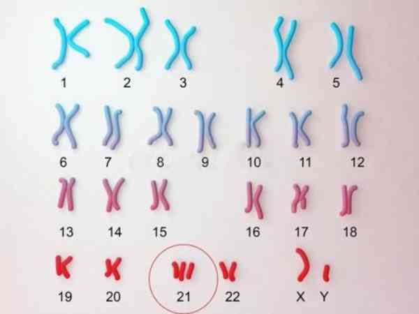 21号染色体片段重复33.83mb会导致怎样的后果？