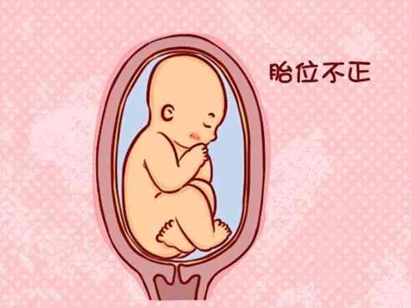 孕期胎儿一直臀位说明宝宝腿部发育有问题吗？