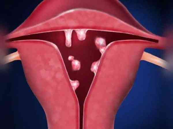 子宫内膜息肉10×6mm严重吗？会不会影响怀孕？