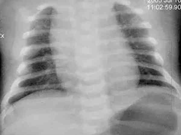 十个新生儿拍ct九个肺部感染是怎么回事？