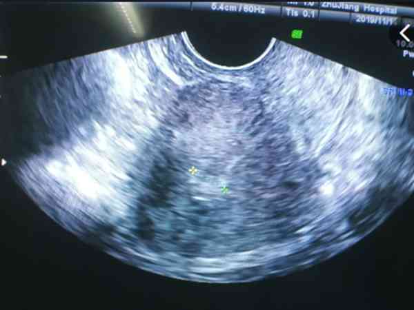 黄体期子宫内膜厚度偏薄只有5mm还会再长吗？