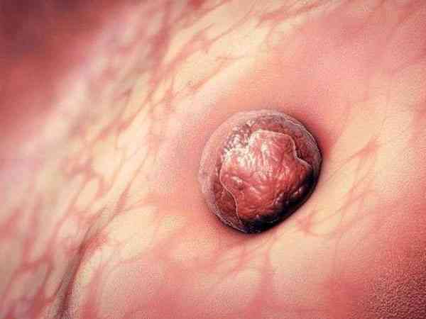 试管胚胎移植七次不着床是胰岛素抵抗导致的吗？