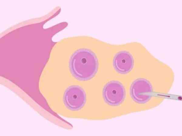 取卵后第二个月月经推迟，b超查出卵巢囊肿怎么办？
