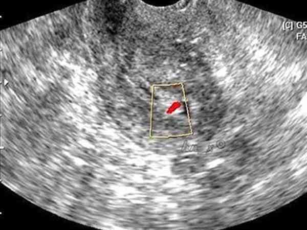 子宫内膜下见血流1级信号会影响试管成功率吗？