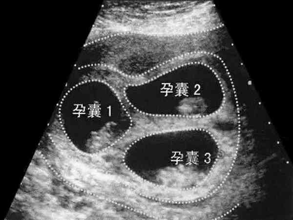 促排卵怀了三胞胎怎么办？一定要减胎一个吗？