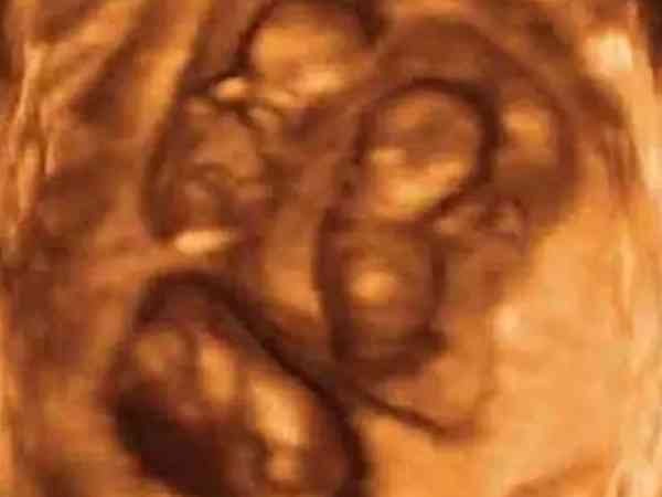 三胞胎剖腹产和孕7周减胎哪个风险大一点？