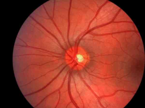 糖尿病引起视网膜病变会影响做试管的成功率吗？