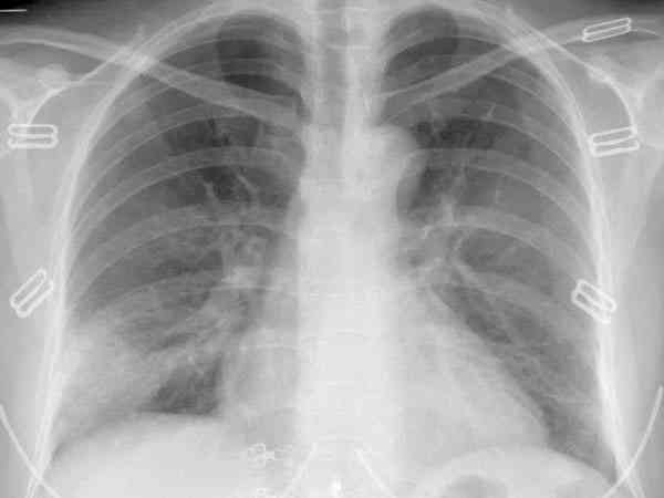 肺脓肿伴有肺炎可以正常备孕要孩子吗？