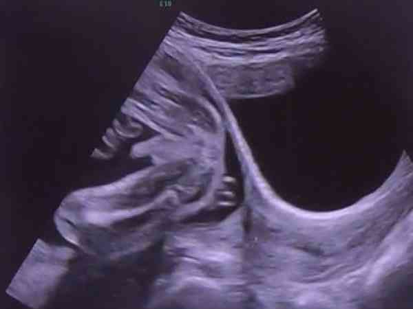 子宫破裂修复三年后可以做试管婴儿成功生育吗？