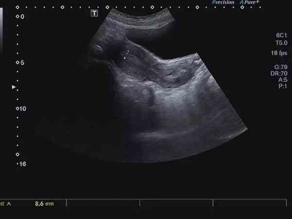 单角子宫试管婴儿移植囊胚着床困难吗？