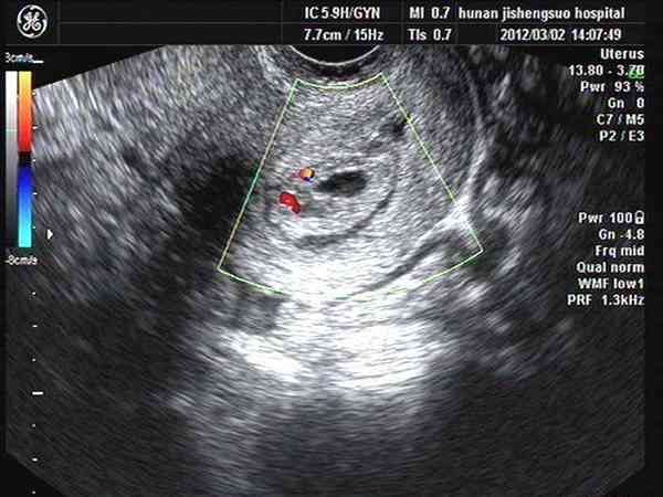 试管移植胚胎会出现宫颈妊娠的情况吗？