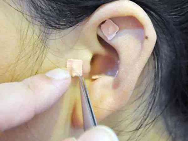 做试管移植前耳朵上贴的小膏药是什么？有什么用？