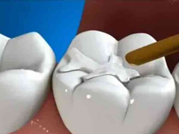 试管婴儿移植后可以补牙打麻醉吗？对着床有没有影响？