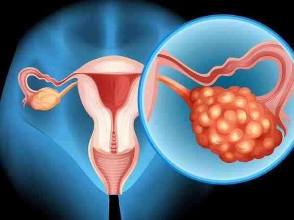 卵巢大对胚胎移植有影响吗？会导致着床失败吗？