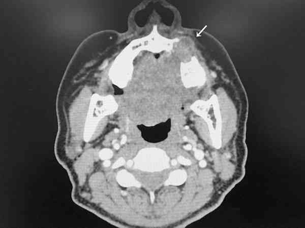 良性多形性腺瘤术后一年没复发能怀孕生小孩吗？