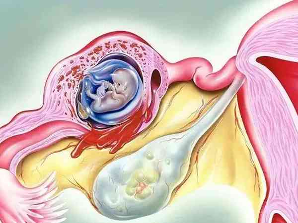 两次宫外孕切除一侧输卵管后备孕做试管还是自然怀好？