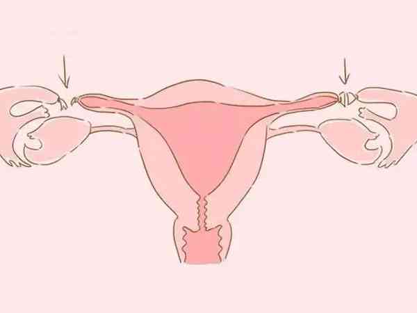 女性两侧输卵管结扎后做几代试管婴儿成功率高？
