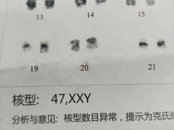 XXY染色体可以到昆明云大医院做试管生育宝宝吗？