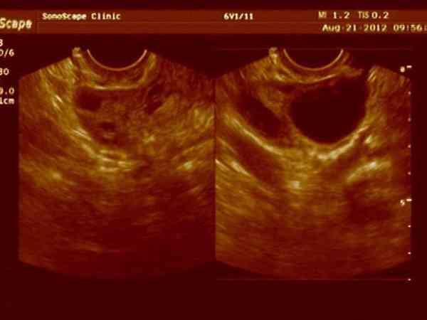 1型残角子宫可以在乌鲁木齐哪家医院做试管要二胎？