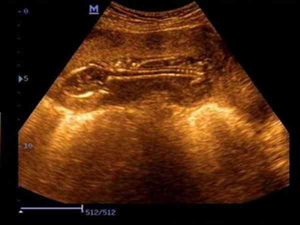 试管婴儿移植囊胚38天孕50天宝宝长多大了？