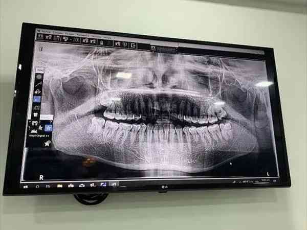 试管移植前一个月拔智齿了拍X片会影响胚胎着床吗？