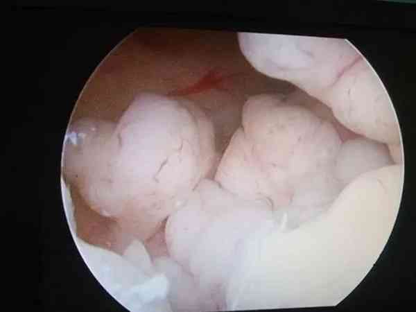子宫内膜不典型增生不治疗影响胚胎移植吗？