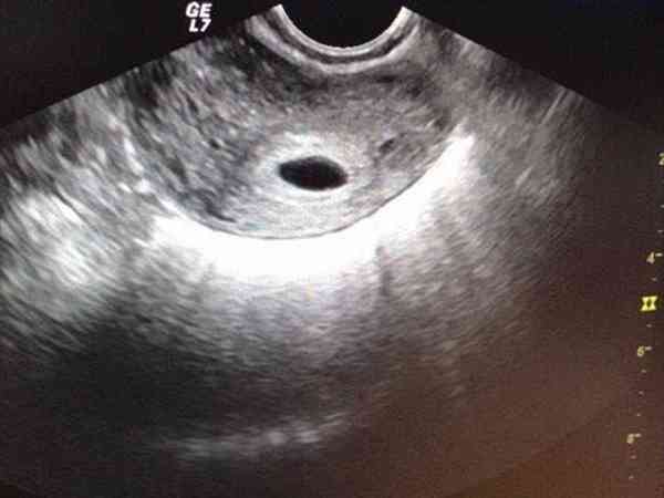 试管婴儿有空囊同批胚胎还会空囊吗？
