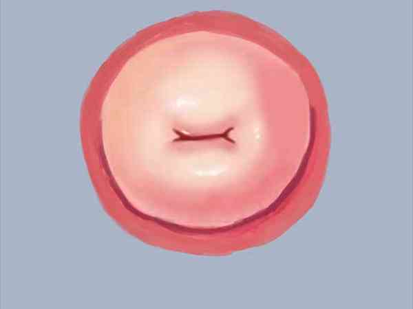 宫颈口小对试管婴儿移植胚胎有影响吗？