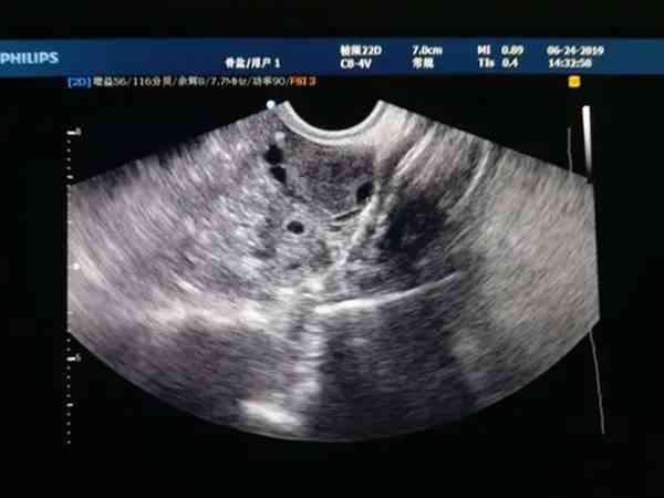 移植第十天有透明液体流出一定就是宫外孕吗？