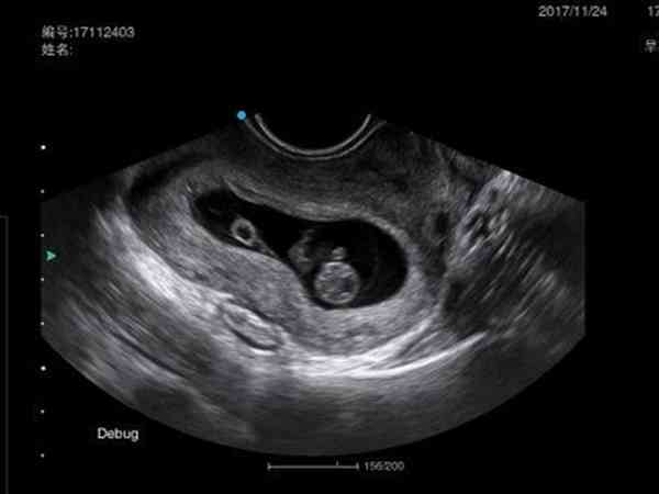 胚胎移植成功后28天一超做阴超有影响吗？