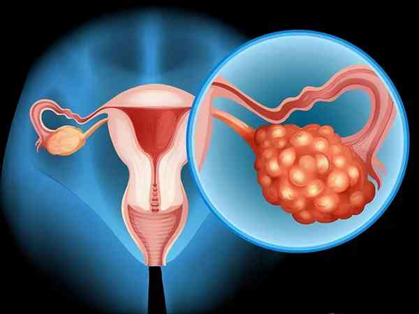 为什么卵巢增大不能移植囊胚？成功率低是主要原因