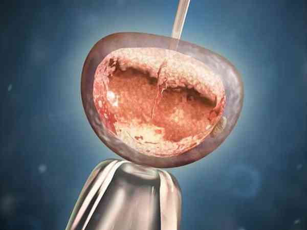 胚胎移植后孕酮越高越好吗？超过标准范围危害可不小