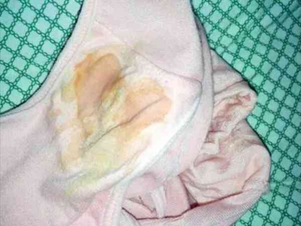 试管婴儿移植后偶尔有一团黄绿色白带是着床成功了吗？