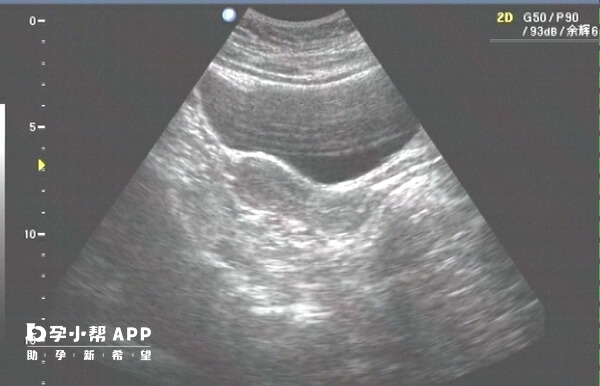 超声诊断子宫体的长低于5厘米可能是幼稚子宫
