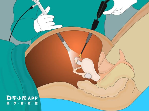 子宫融合手术治疗始基子宫