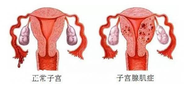 正常子宫与子宫腺肌症对比图
