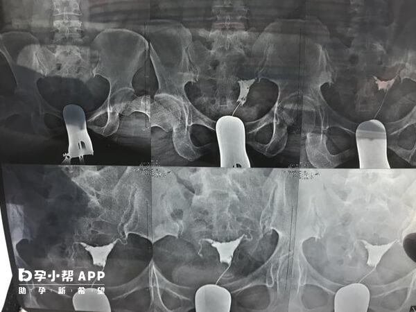 沧州二院做输卵管造影很好