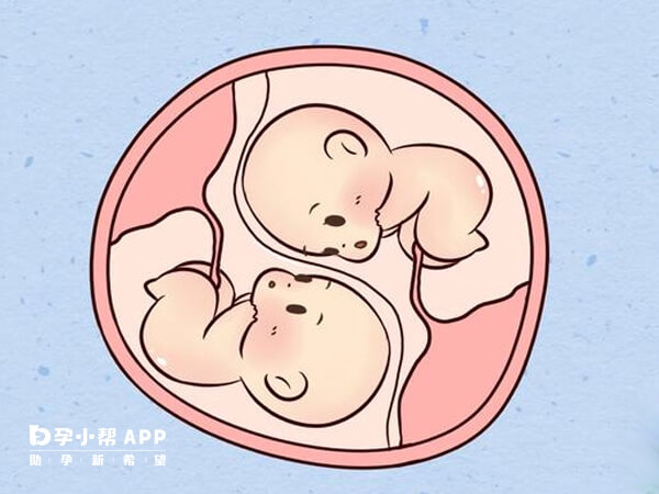 双胞胎减胎有风险存在