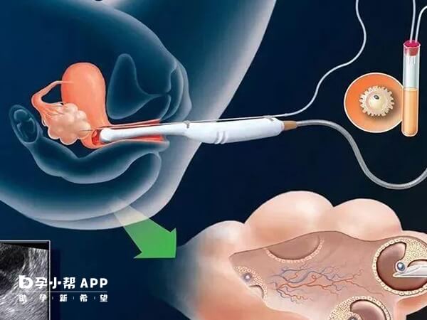 穿刺针取卵