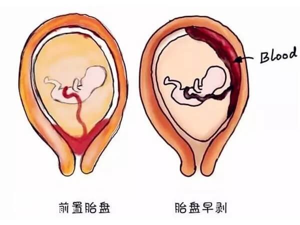 胎盘早剥可能危及胎儿生命