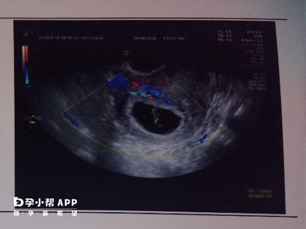 孕早期B超检查孕囊偏右是正常的