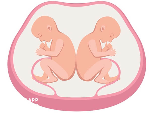 单卵双胎共用一个胎盘