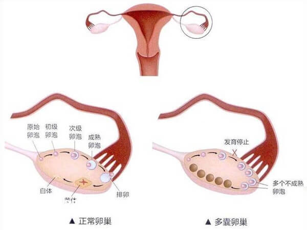 多囊卵巢与正常卵巢对比图
