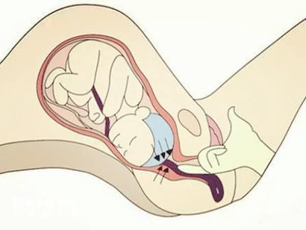 胎盘低置与孕期时间短有关系