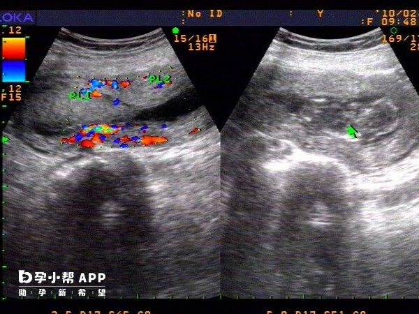 临床上胚胎停育用b超诊断